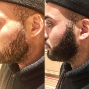 Wondering how to get a thicker beard? 4RootZ has you covered with a new  option.