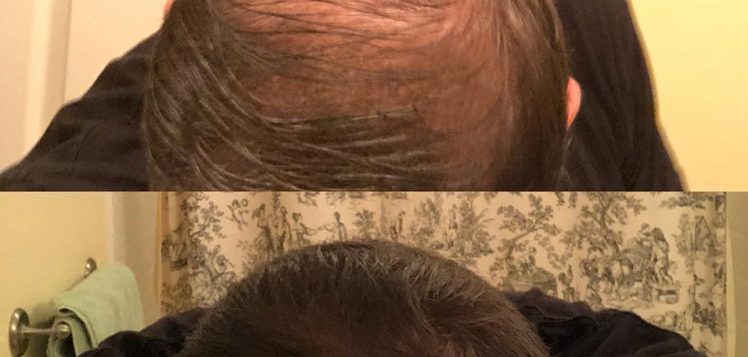 Cover bald spot with hair thickening gel 4RootZ